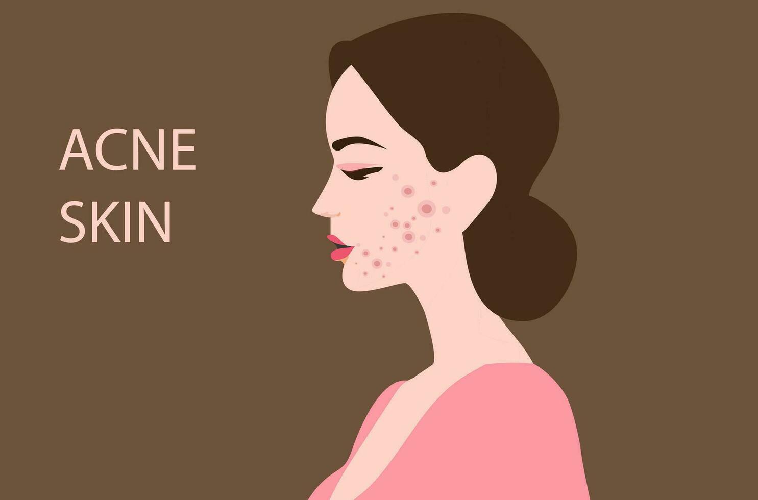 Woman face with skin acne, pimples, blackheads vector illustration.