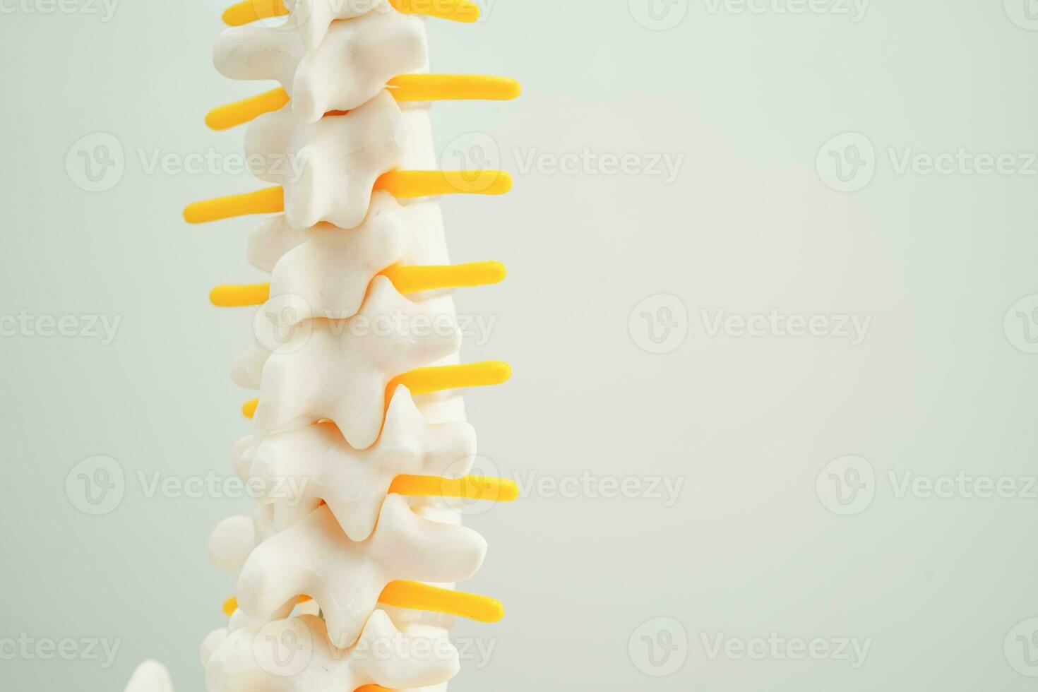 Spinal nerve and bone, Lumbar spine displaced herniated disc fragment, Model for treatment medical in the orthopedic department. photo