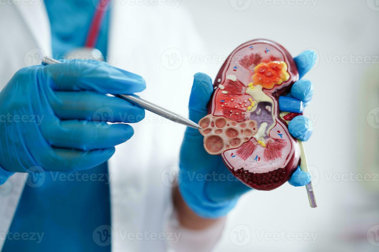 Chronic kidney disease, doctor holding model for treatment urinary system, urology, Estimated glomerular filtration rate eGFR. photo