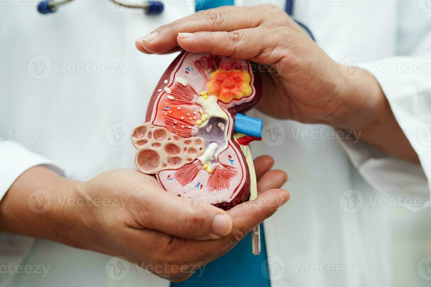 Chronic kidney disease, doctor holding model for treatment urinary system, urology, Estimated glomerular filtration rate eGFR. photo