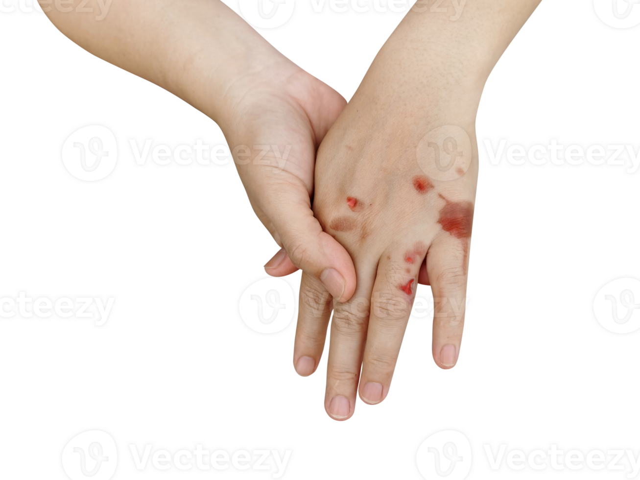 Hands with blisters from heat PNG transparent