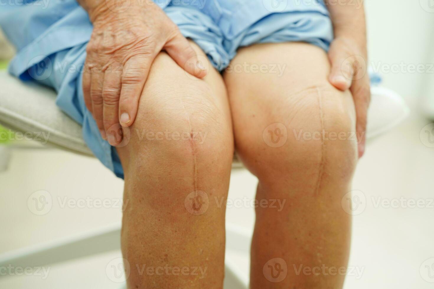 Paciente anciana asiática con cirugía de reemplazo de rodilla con cicatriz en el hospital. foto