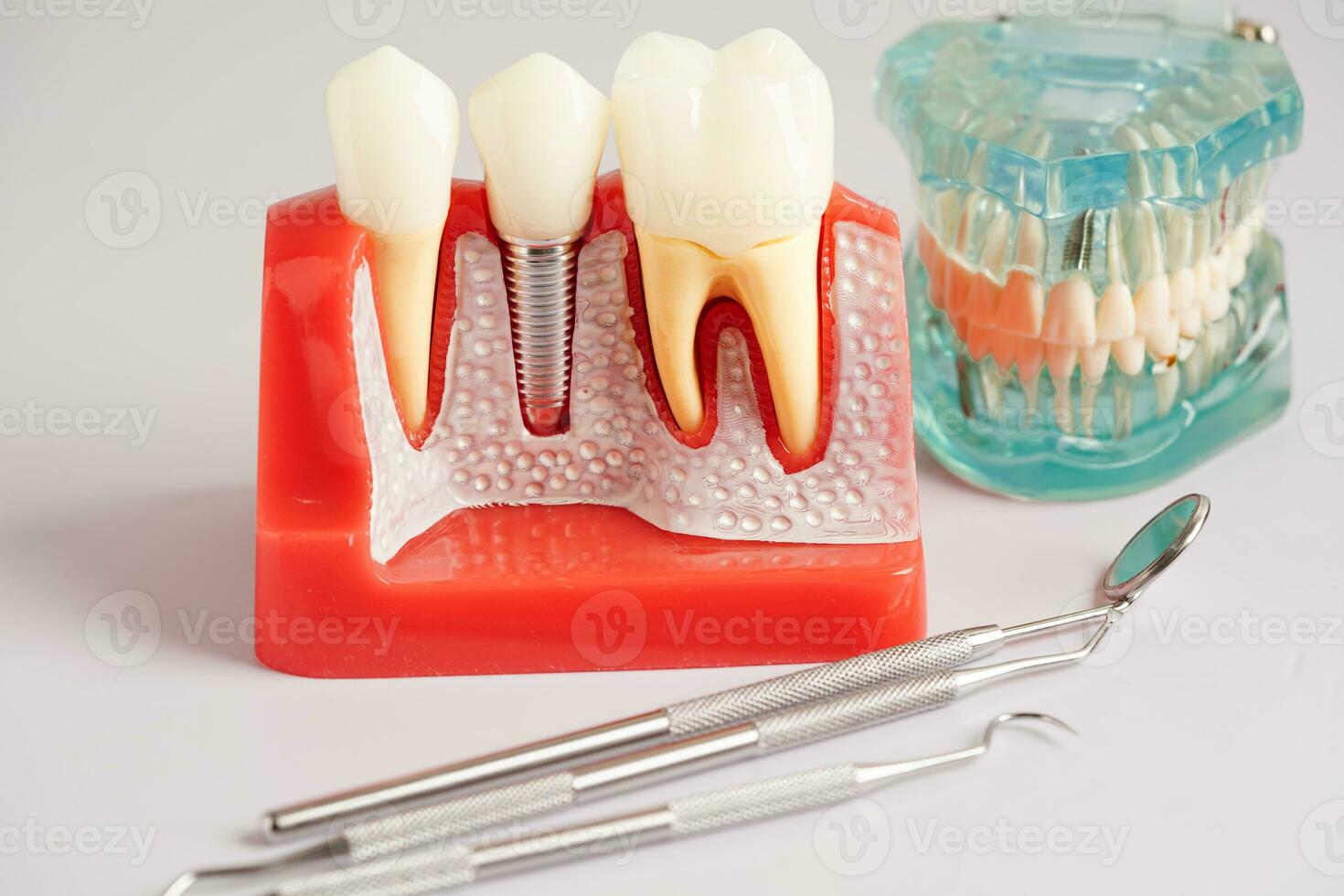 Dental implant, artificial tooth roots into jaw, root canal of dental treatment, gum disease, teeth model for dentist studying about dentistry. photo