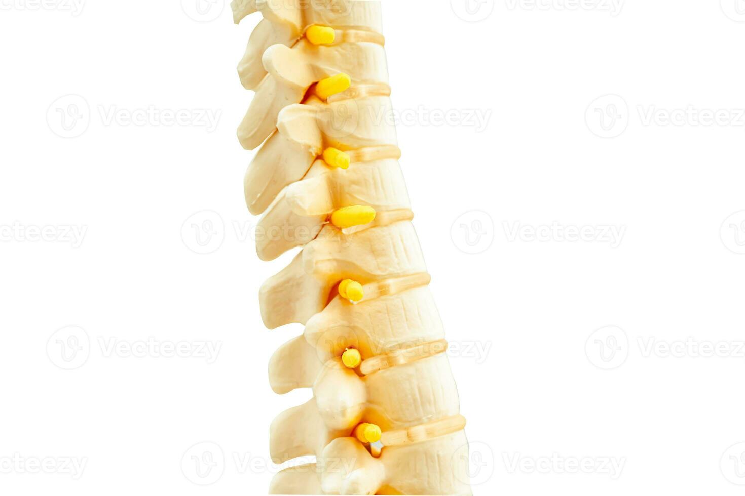 Lumbar spine displaced herniated disc fragment, spinal nerve and bone. Model for treatment medical in the orthopedic department. photo