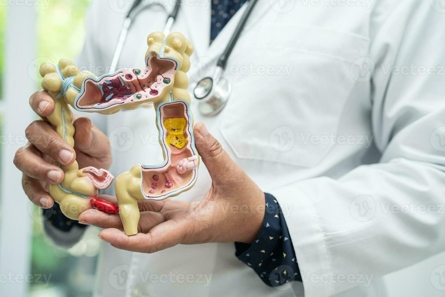 intestino, apéndice y digestivo sistema, médico participación anatomía modelo para estudiar diagnóstico y tratamiento en hospital. foto