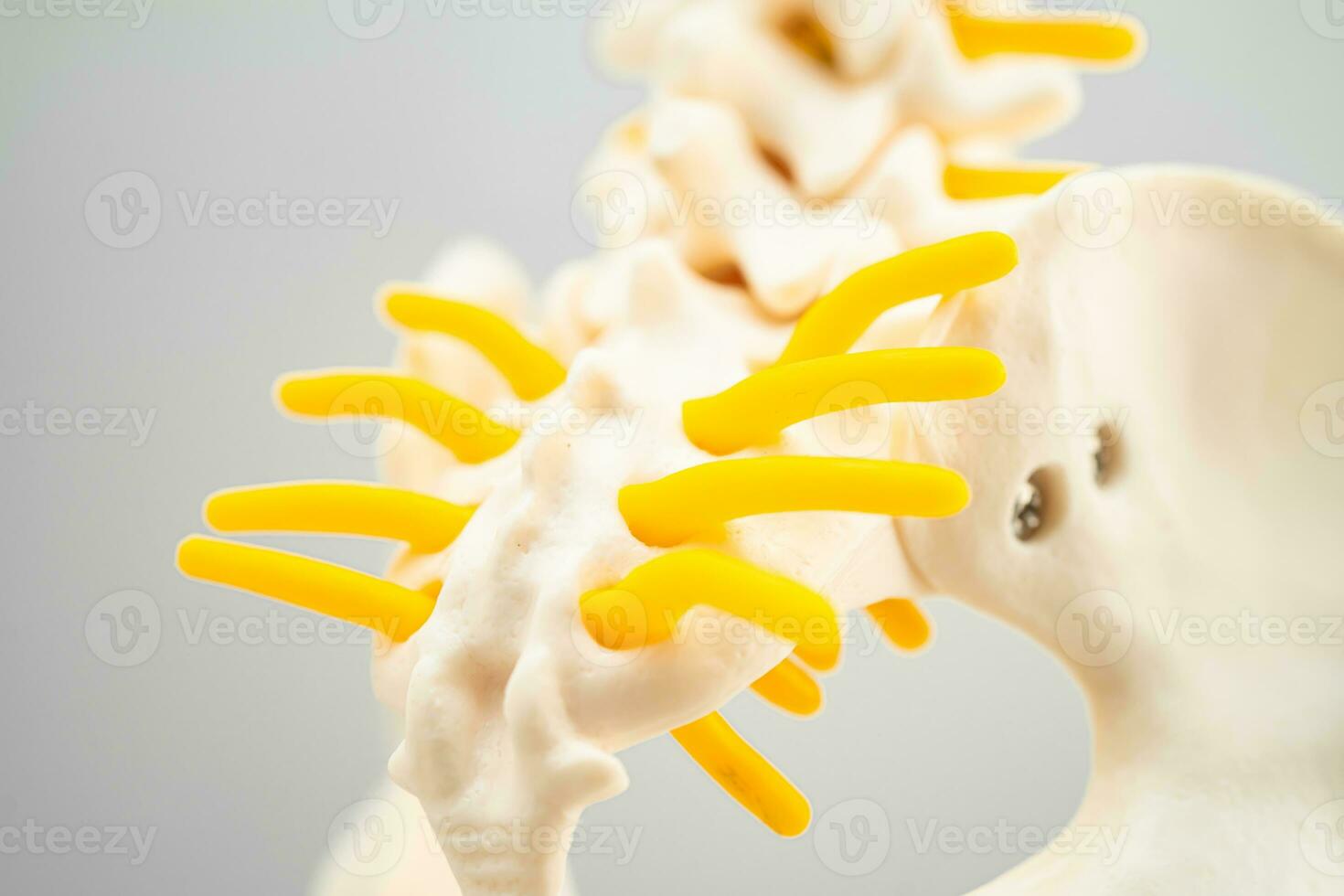 Lumbar spine displaced herniated disc fragment, spinal nerve and bone. Model for treatment medical in the orthopedic department. photo