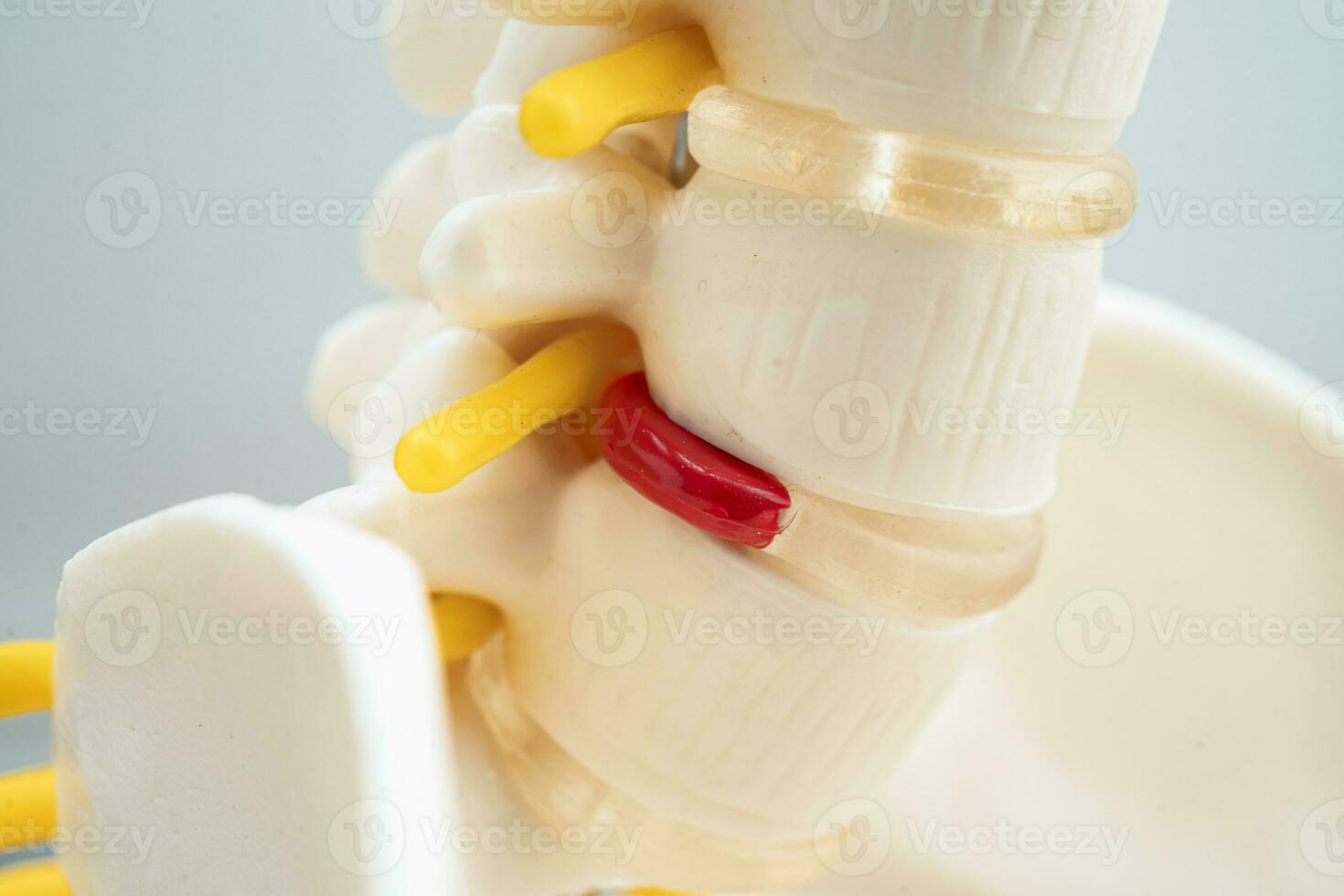 Lumbar spine displaced herniated disc fragment, spinal nerve and bone. Model for treatment medical in the orthopedic department. photo