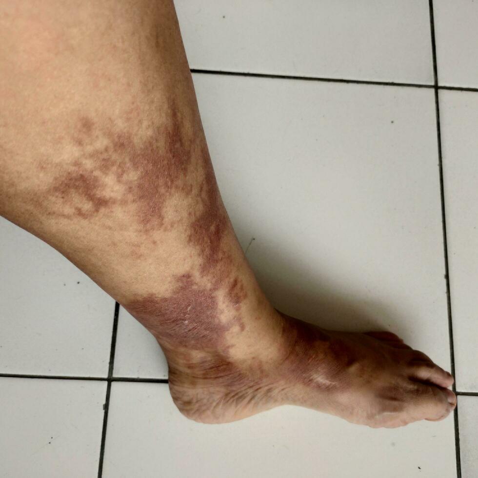 Horrible burns on left leg. Burns due to being scalded by hot water. Blistered skin. Reddish skin photo