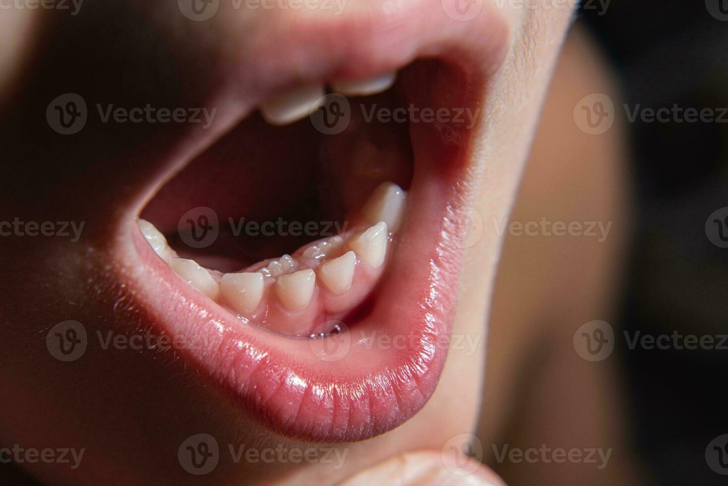 The boy's molars are erupting when the milk teeth have not yet fallen out. Anomaly. Close-up photo