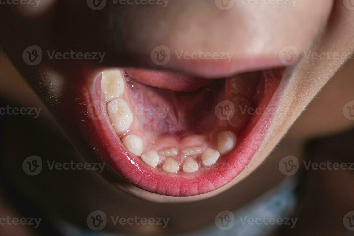 The boy's molars are erupting when the milk teeth have not yet fallen out. Anomaly. Close-up photo