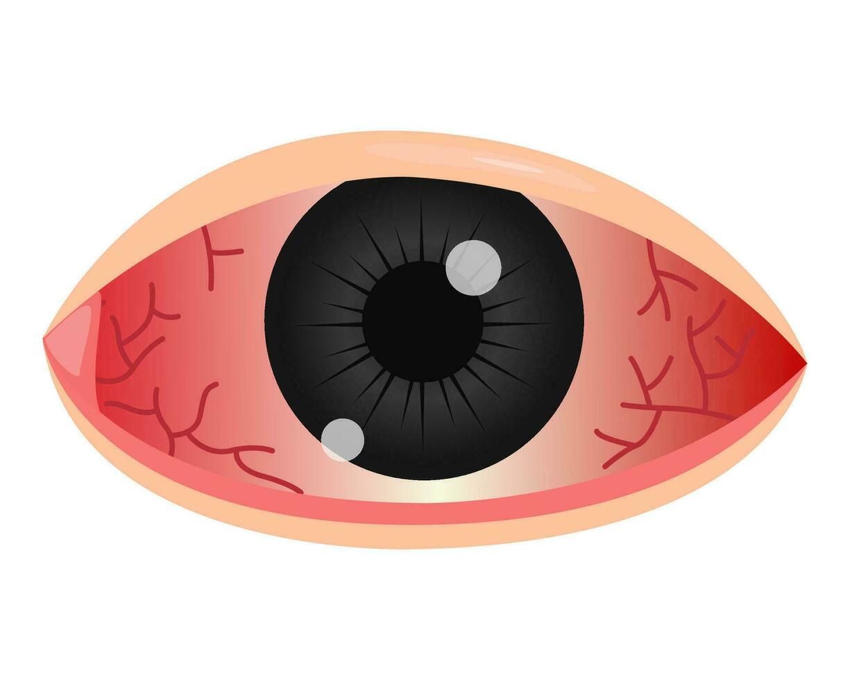rojo ojo conjuntivitis. vector ilustración