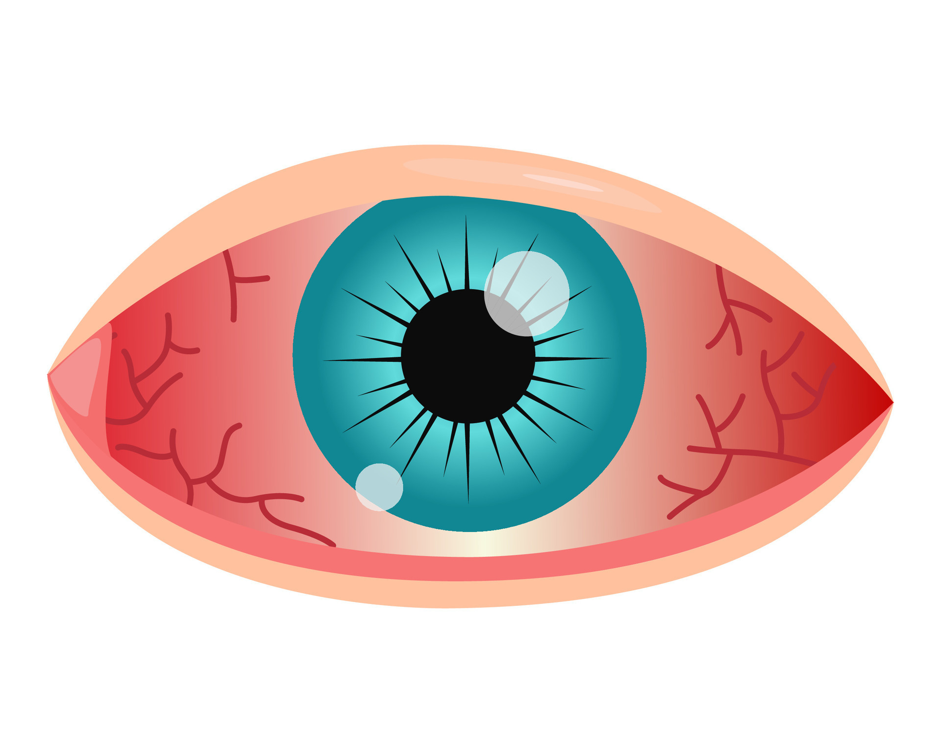 red eye conjunctivitis. vector illustration 33517808 Vector Art at Vecteezy