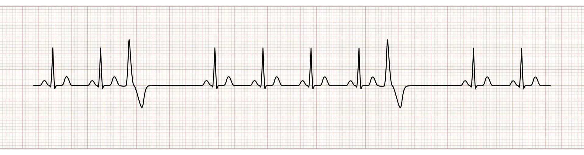 EKG Monitor Showing  Sinus Rhythm with PVC vector