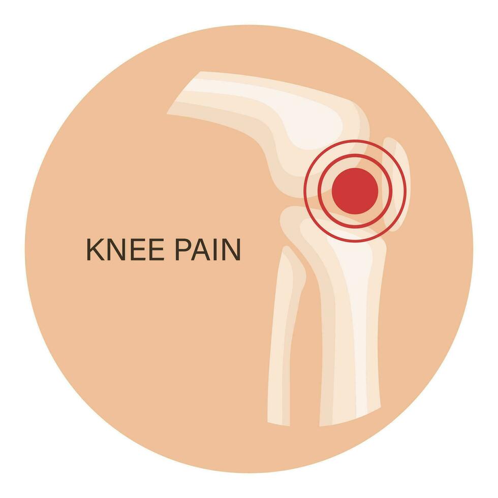 Knee pain, osteoarthritis, rheumatoid arthritis. Anatomy of human bones. Medicine. Illustration, vector