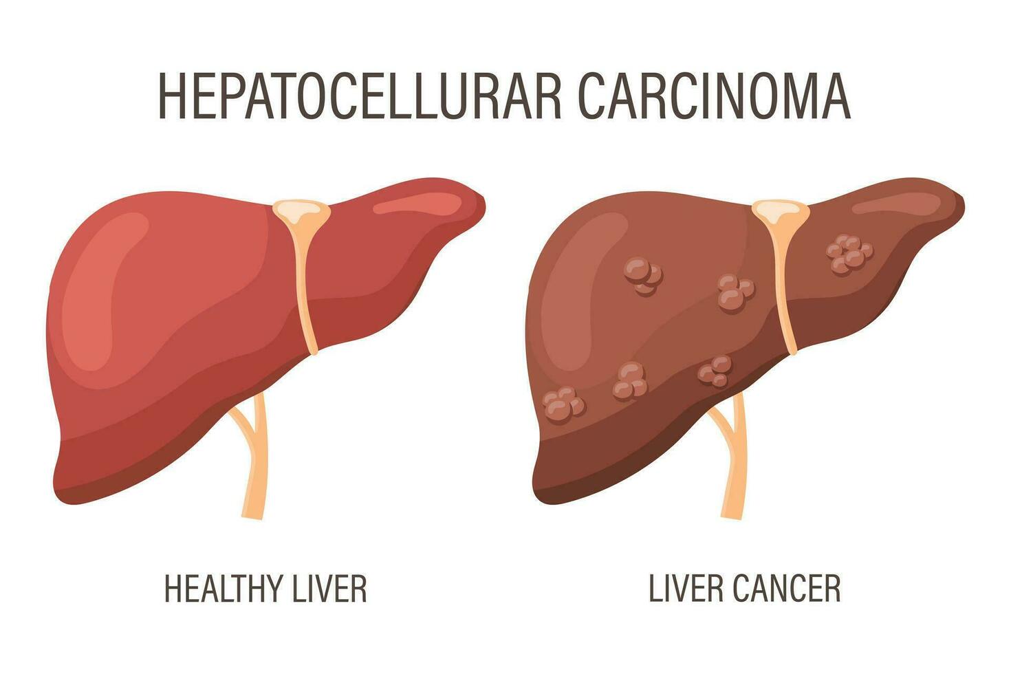 hepatocelular carcinoma, hígado enfermedades. sano hígado y hígado cáncer. médico infografía bandera. vector