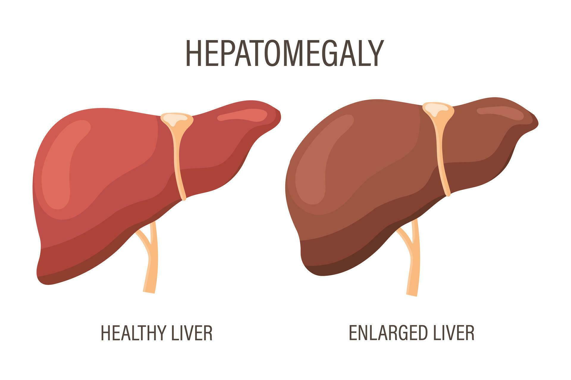 Hepatomegaly, liver diseases. Healthy liver and enlarged liver. Medical