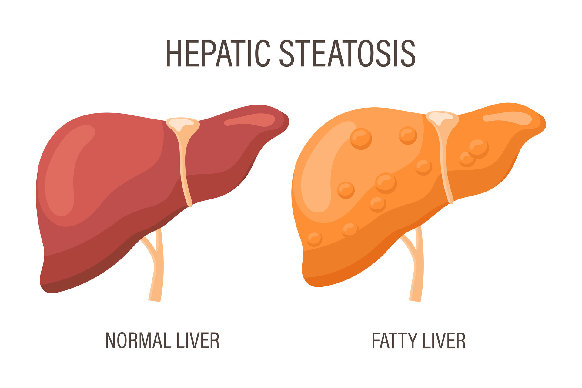 Liver steatosis, liver diseases. Healthy liver and fatty liver. Medical