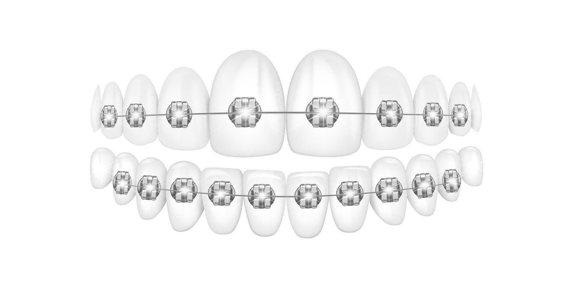 Ilustración de vector 3d, dientes realistas con aparatos ortopédicos. alineación de la mordida de los dientes, dentición con frenos, frenos dentales.