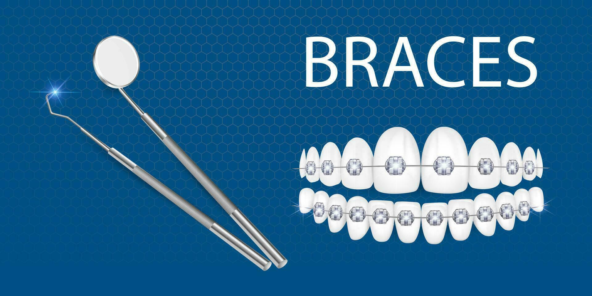 Ilustración de vector 3d, dientes realistas con aparatos ortopédicos. alineación de la mordida de los dientes, dentición con frenos, frenos dentales.