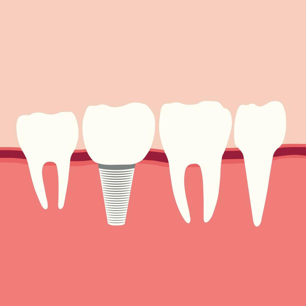 cirugía molar con diente implante reemplazo en chicle. para bueno dental sano dientes. tornillo dentadura ortodoncia implantación. estomatología clínica y dental implante concepto. realista 3d vector. vector