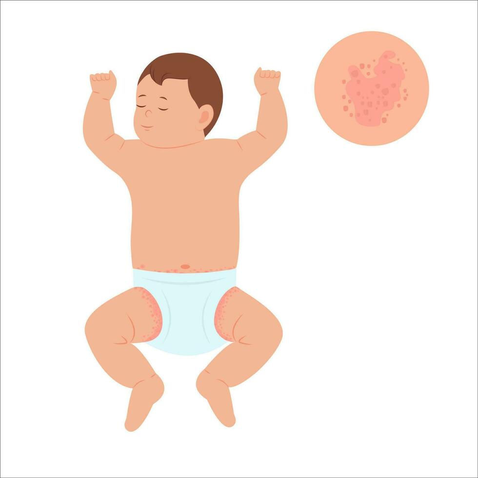 Baby with diaper rash, skin rash, allergy. Redness of skin in children.Dermatological problems. Vector illustration