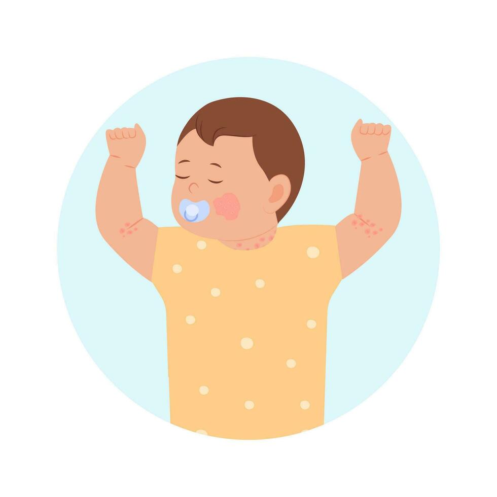 pediátrico eczema o atópico dermatitis en infantes y niños. bebé con pañal erupción, piel erupción, alergia. enrojecimiento de piel en niños.dermatologicos problemas. vector ilustración