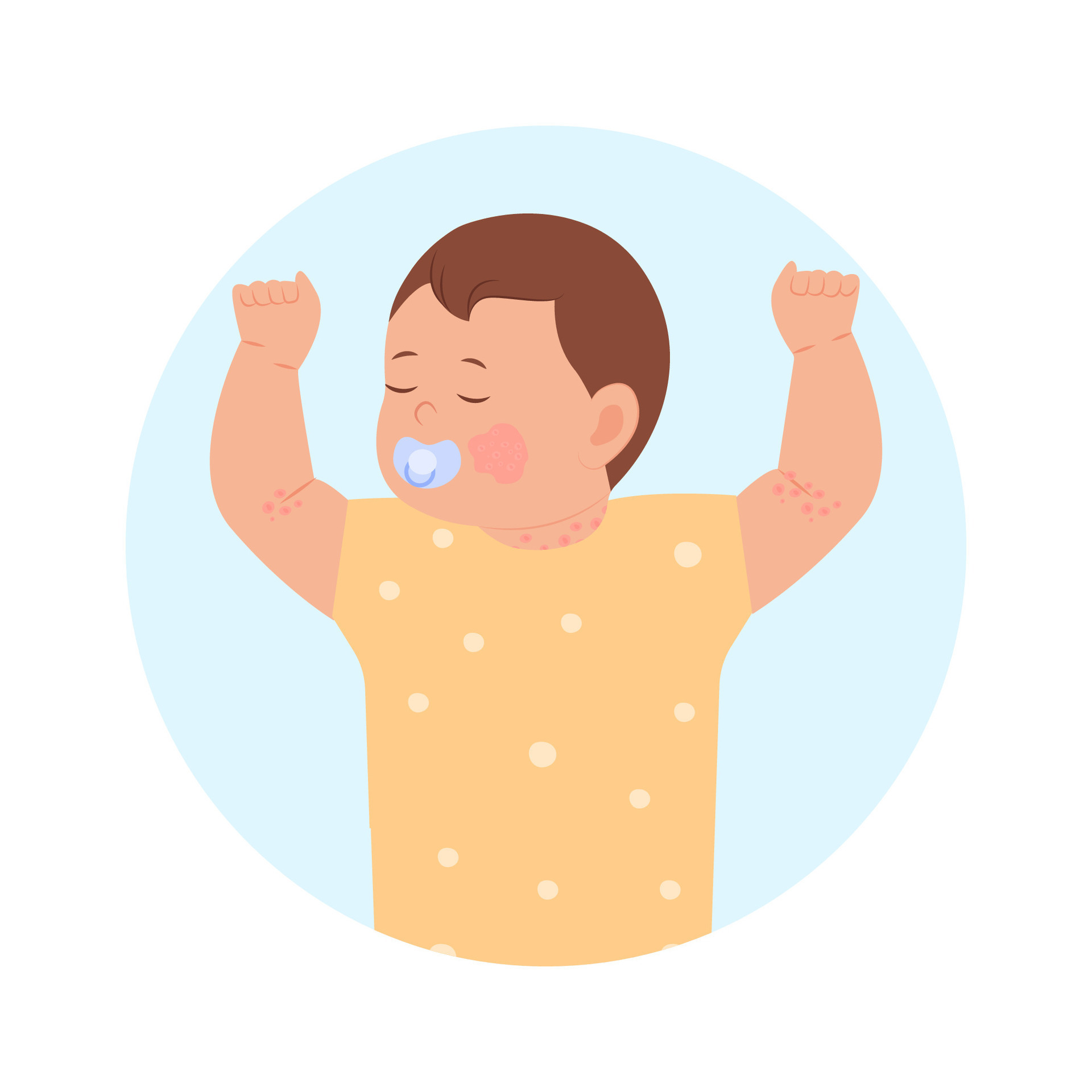 Pediatric Eczema or Atopic Dermatitis in infants and children. Baby with diaper rash, skin rash