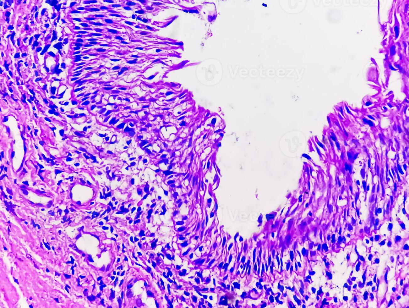 Histology of urachal cyst. Photomicrograph of histological stained slide showing Urachal cyst. Urethral cyst. photo