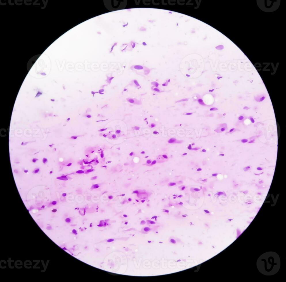 Photomicrograph showing Neurofibroma. Neurofibromatosis, is a genetic disorder, gene mutations. photo