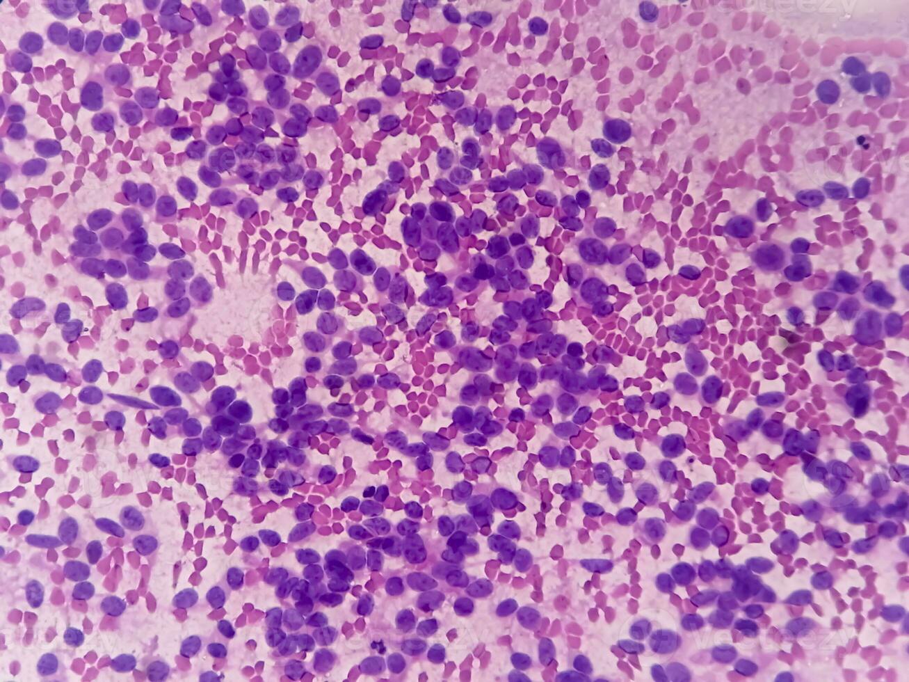USG guided FNA cytology of liver SOL showing Non Hodgkin lymphoma. Metastatic carcinoma photo