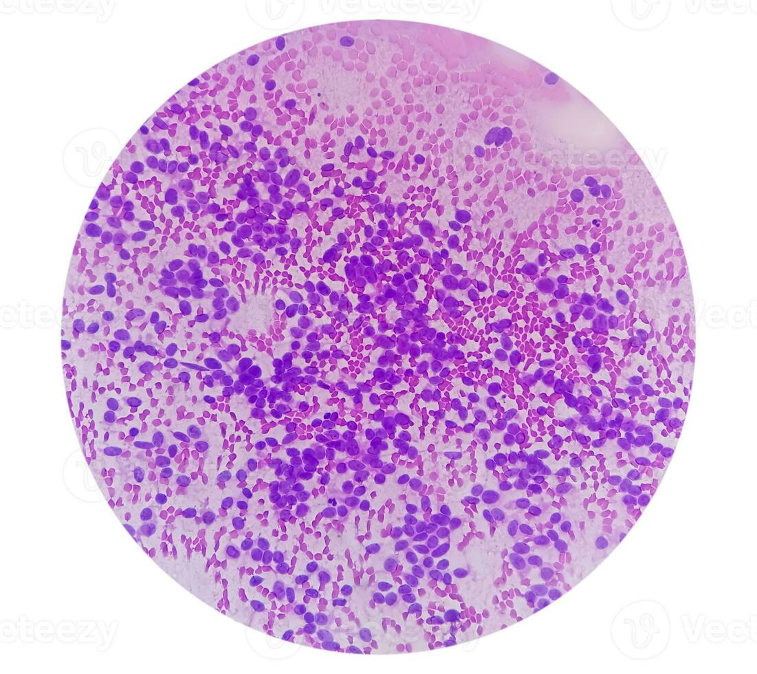 USG guided FNA cytology of liver SOL showing Non Hodgkin lymphoma. Metastatic carcinoma photo