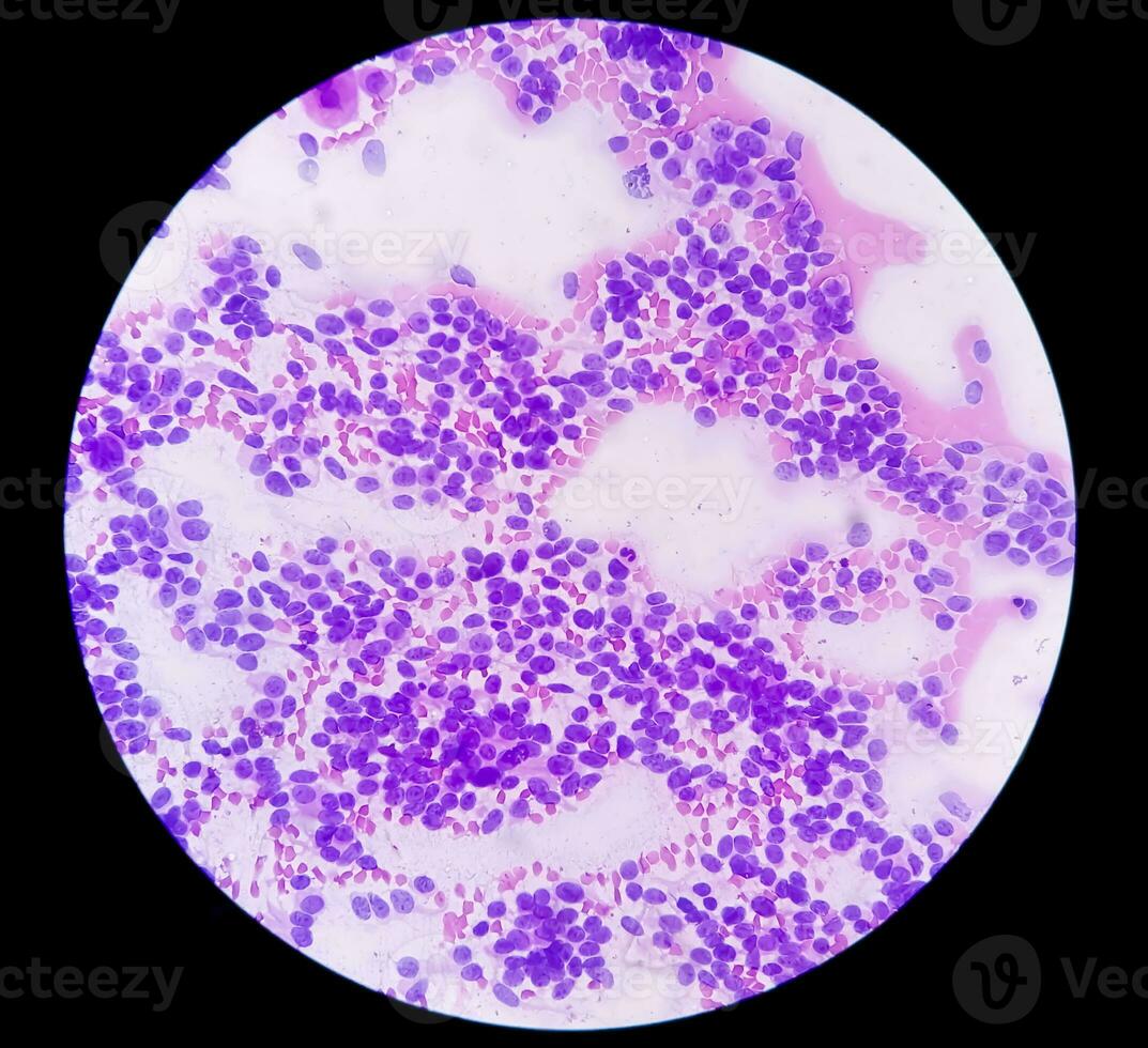 USG guided FNA cytology of liver SOL showing Non Hodgkin lymphoma. Metastatic carcinoma photo