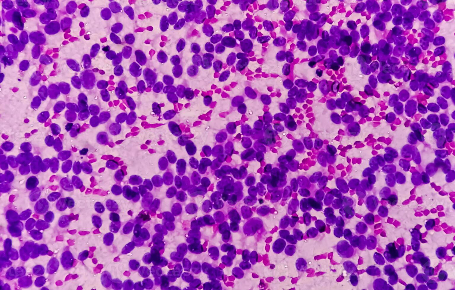 USG guided FNA cytology of liver SOL showing Non Hodgkin lymphoma. Metastatic carcinoma photo