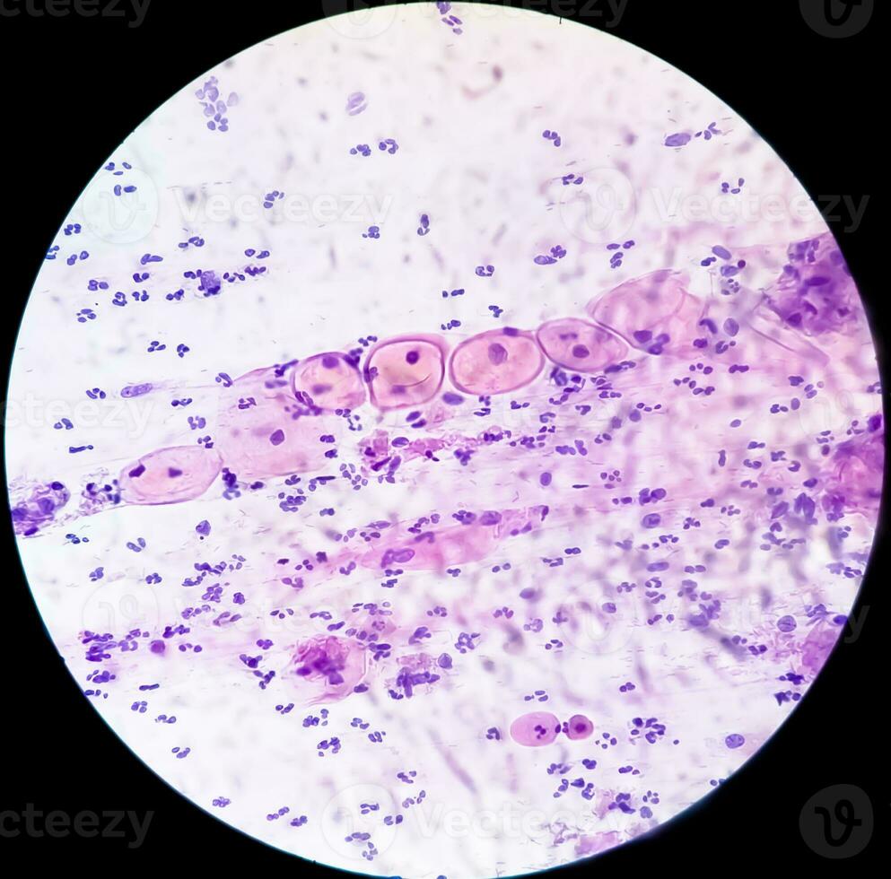 Photomicrograph of Paps smear showing Inflammatory smear with HPV related changes. Cervical cancer. SCC photo