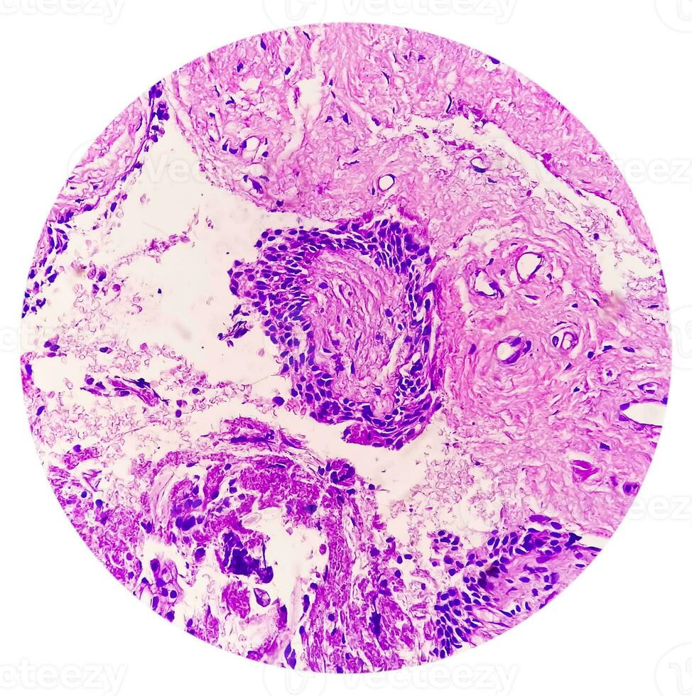 Histology of urachal cyst. Photomicrograph of histological stained slide showing Urachal cyst. Urethral cyst. photo