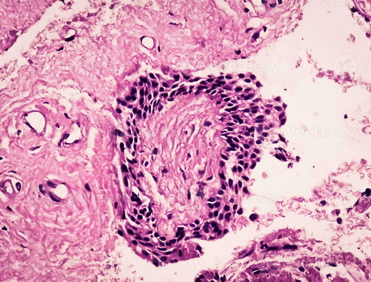 Histology of urachal cyst. Photomicrograph of histological stained slide showing Urachal cyst. Urethral cyst. photo