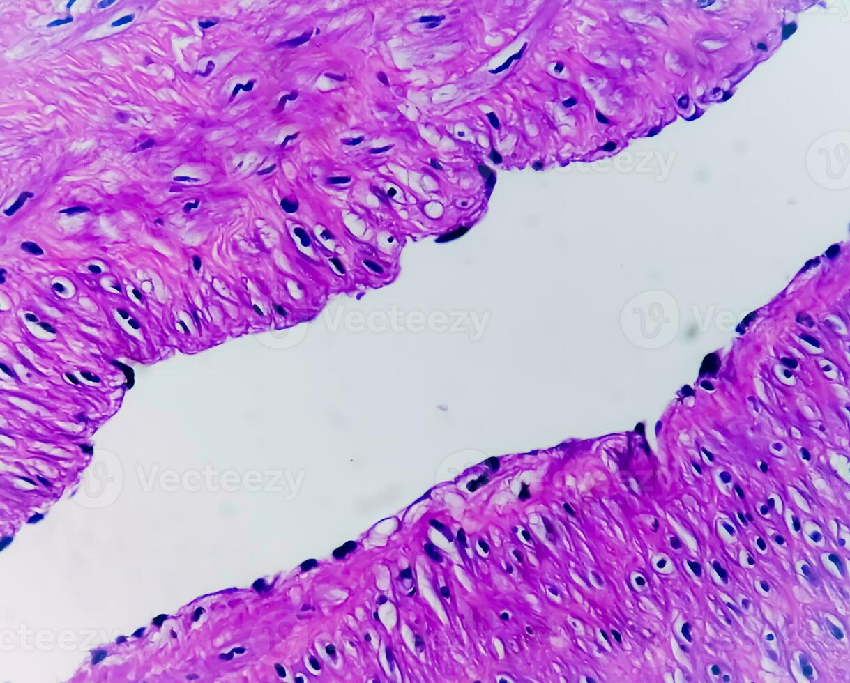 Photomicrograph, Prepatellar region histology showing Bursitis, acute or chronic Bursitis. photo