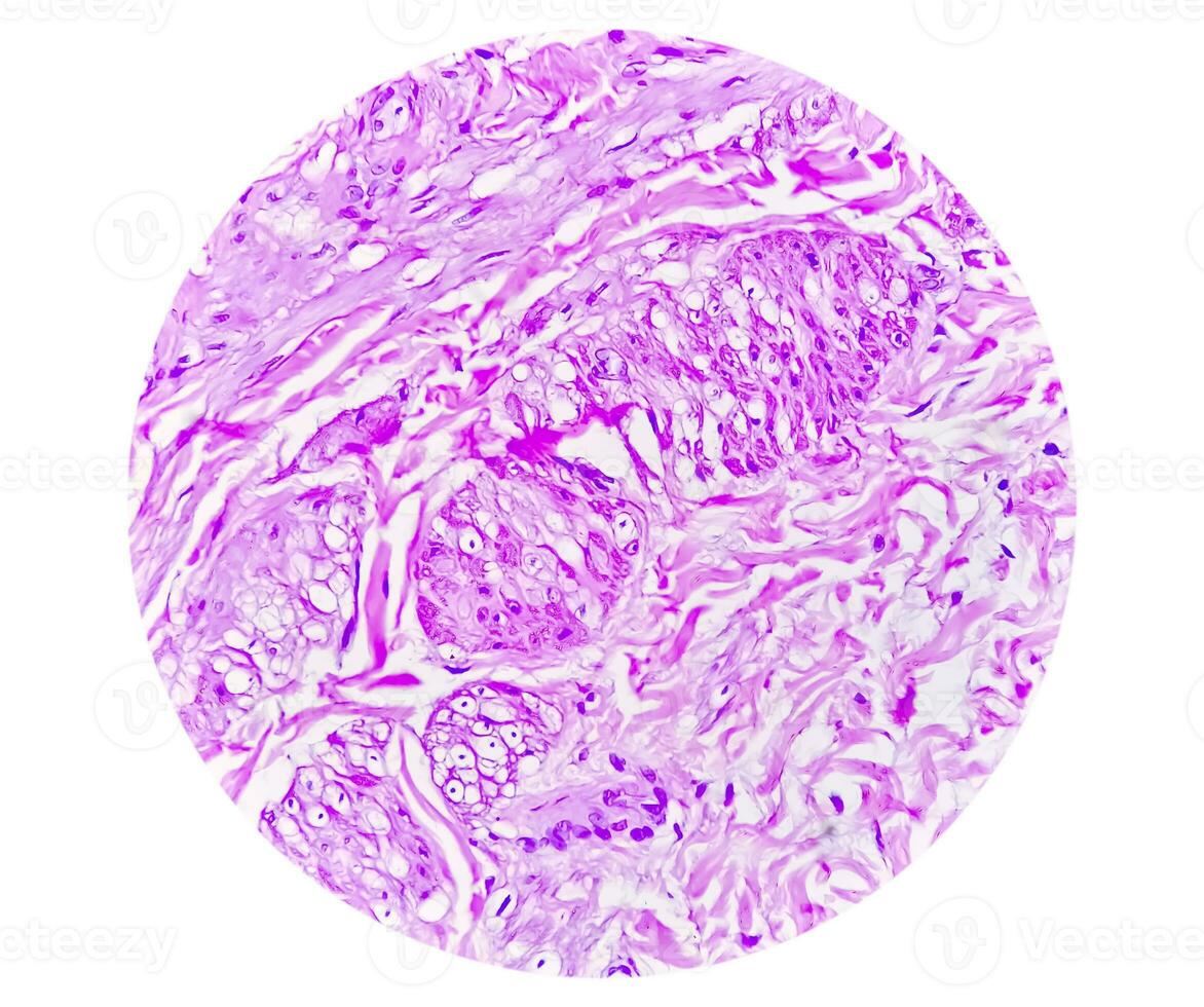 Histology of urachal cyst. Photomicrograph of histological stained slide showing Urachal cyst. Urethral cyst. photo