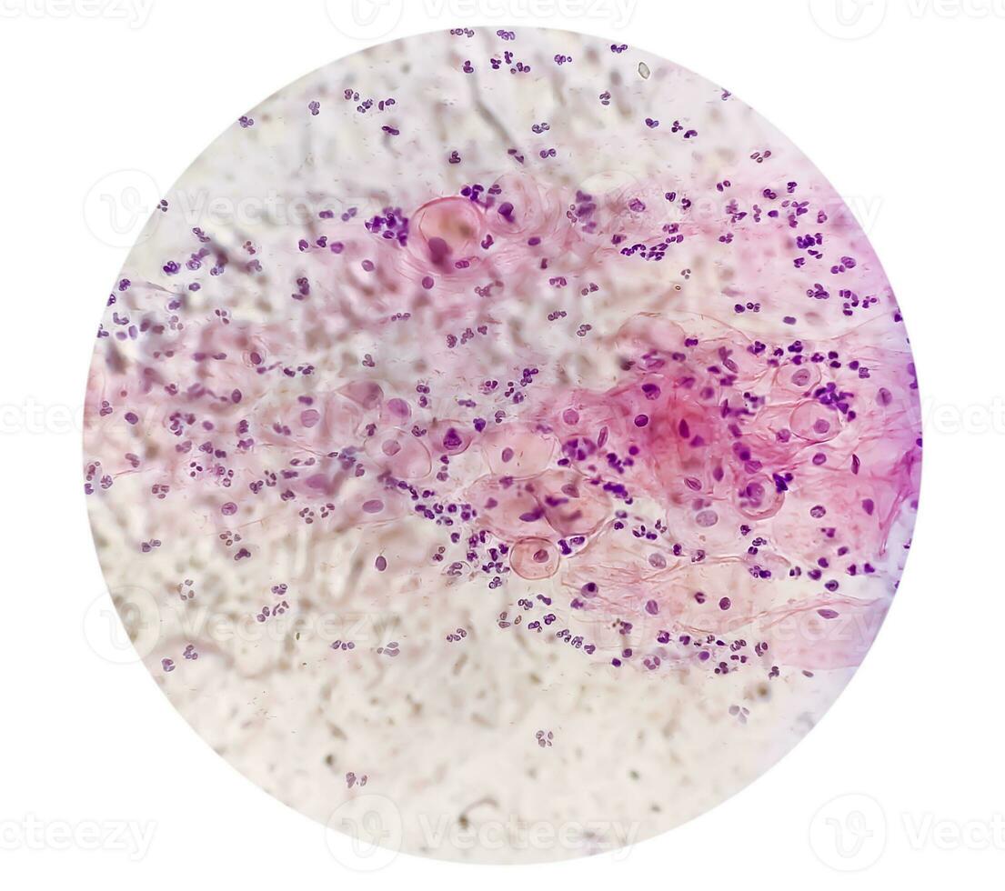 Photomicrograph of Paps smear showing Inflammatory smear with HPV related changes. Cervical cancer. SCC photo