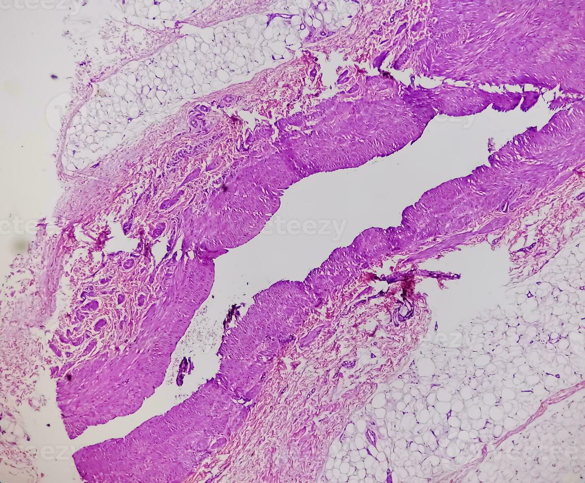 Photomicrograph, Prepatellar region histology showing Bursitis, acute or chronic Bursitis. photo