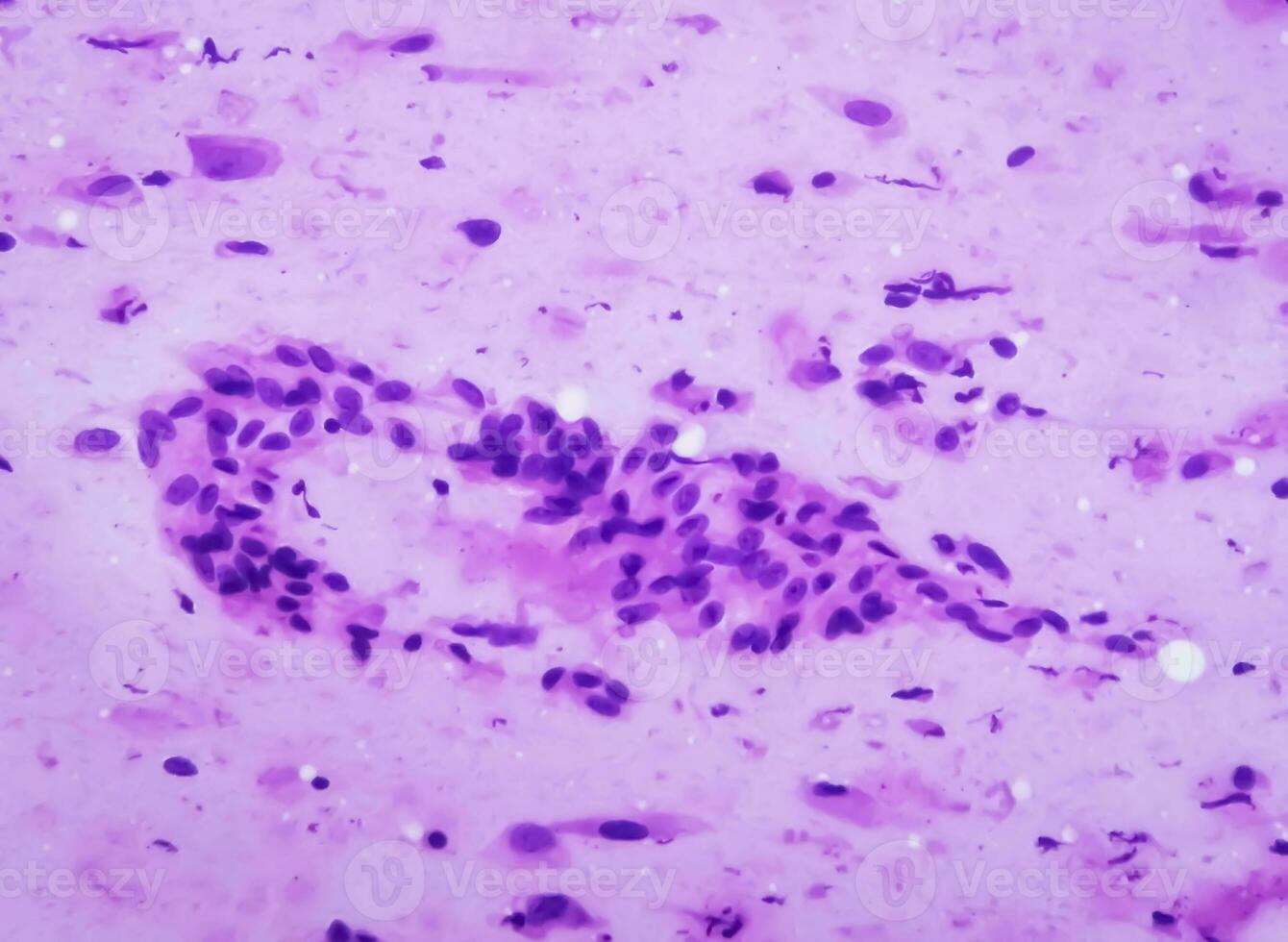 microfotografía demostración neurofibroma. neurofibromatosis, es un genético trastorno, gene mutaciones foto