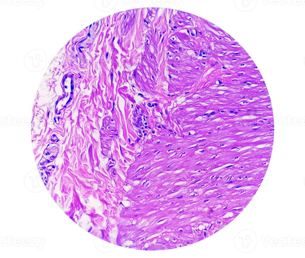 Photomicrograph, Prepatellar region histology showing Bursitis, acute or chronic Bursitis. photo