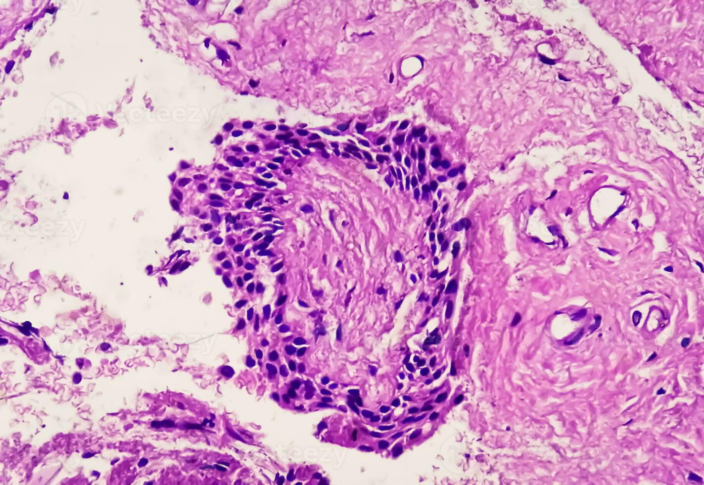 Histology of urachal cyst. Photomicrograph of histological stained slide showing Urachal cyst. Urethral cyst. photo