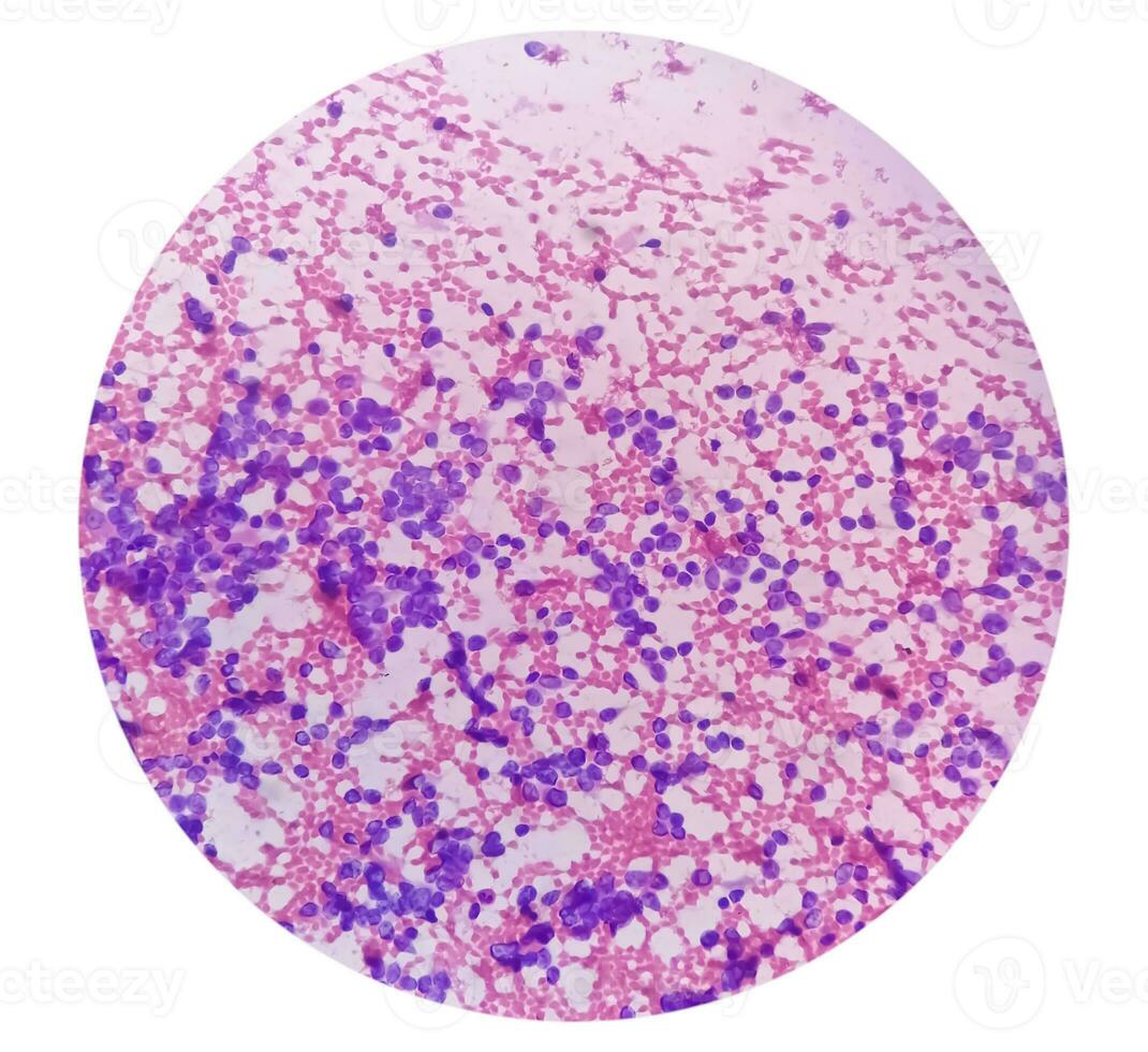 USG guided FNA cytology of liver SOL showing Non Hodgkin lymphoma. Metastatic carcinoma photo