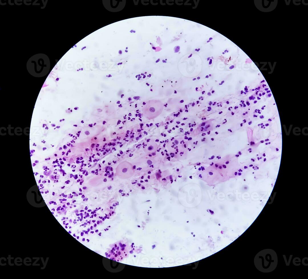 Photomicrograph of Paps smear showing Inflammatory smear with HPV related changes. Cervical cancer. SCC photo