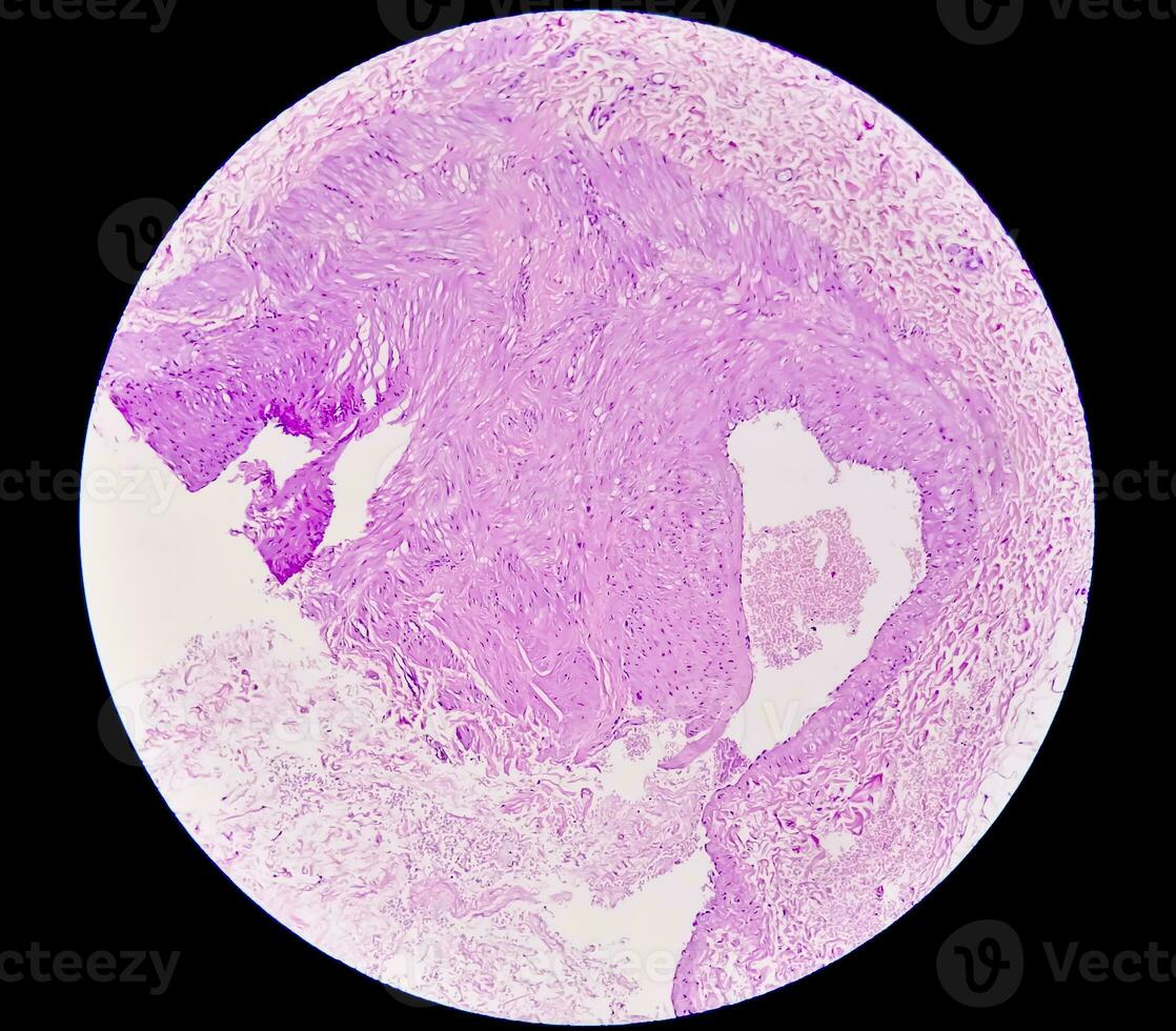 Photomicrograph, Prepatellar region histology showing Bursitis, acute or chronic Bursitis. photo