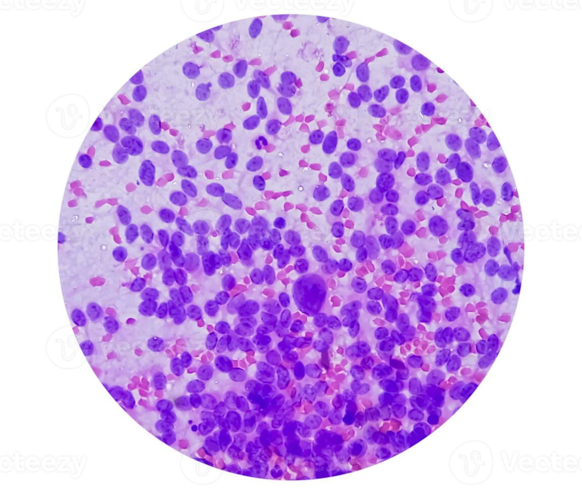 USG guided FNA cytology of liver SOL showing Non Hodgkin lymphoma. Metastatic carcinoma photo