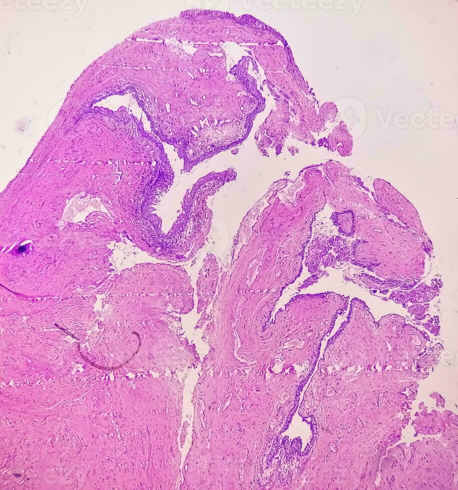 Histology of urachal cyst. Photomicrograph of histological stained slide showing Urachal cyst. Urethral cyst. photo