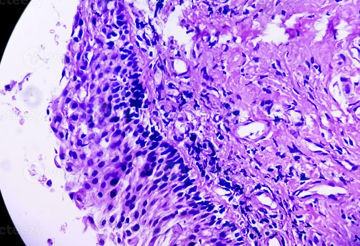 Histology of urachal cyst. Photomicrograph of histological stained slide showing Urachal cyst. Urethral cyst. photo