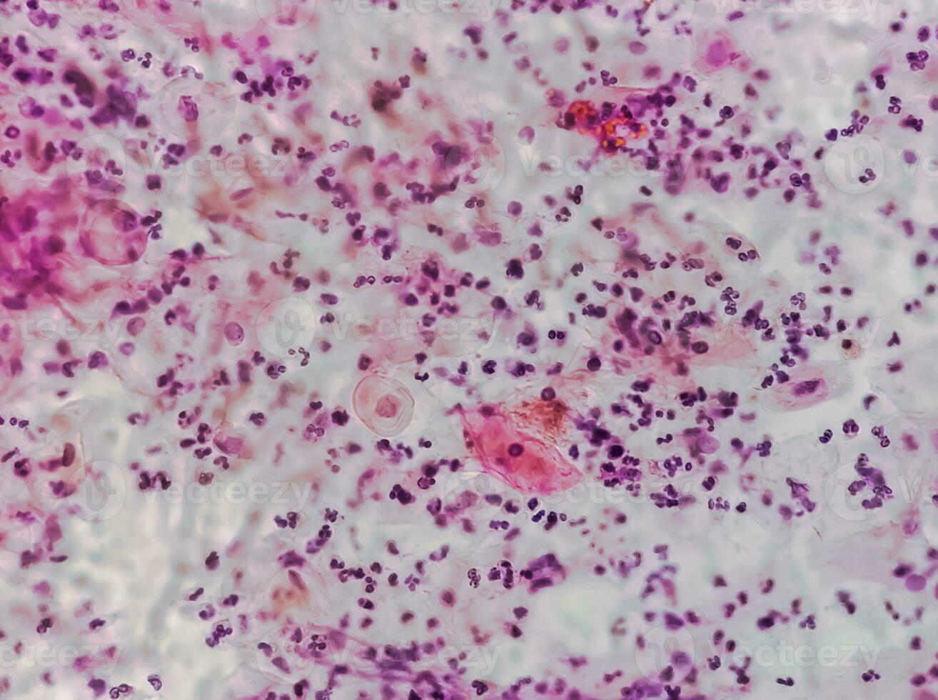 Photomicrograph of Paps smear showing Inflammatory smear with HPV related changes. Cervical cancer. SCC photo